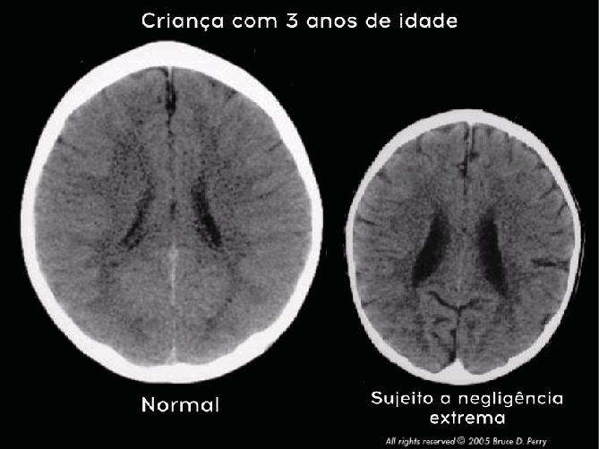 IMPACTO DA NEGLIGÊNCIA NO DESENVOLVIMENTO DO CÉREBRO Perry, B.D. (2002).