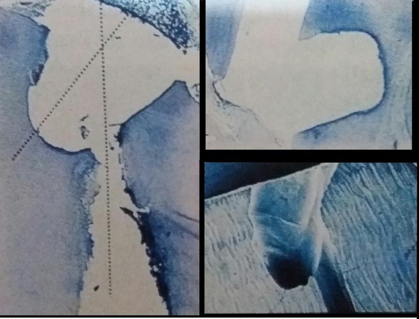 31 Figura 9 - Imagem histopatológica do ápice radicular após apicectomia preparada com broca Fonte: Bernabé & Holland.