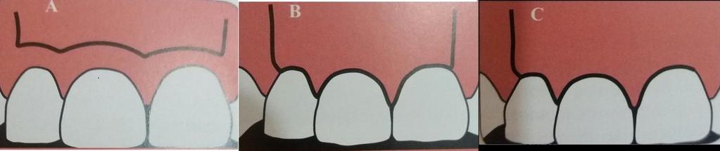 32 extensas, dentes anteriores, preserva áreas estéticas, pode permanecer uma leve cicatriz (figura 11.A).