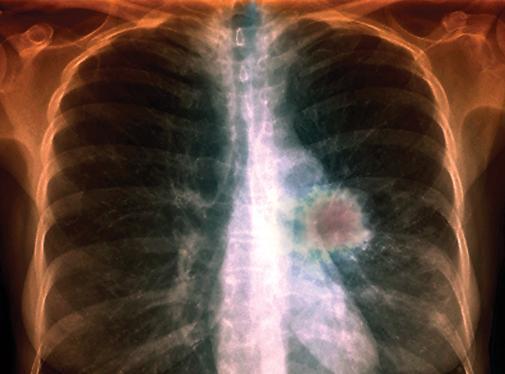 Doenças do sistema respiratório As doenças do sistema respiratório têm grande