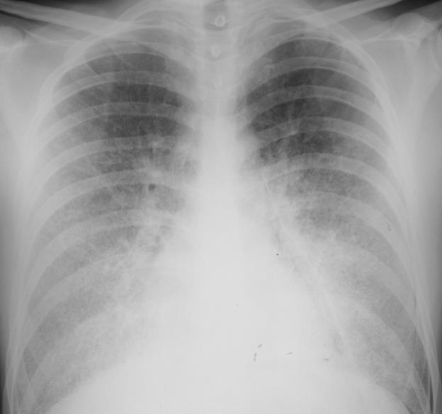 Microlitíase Alveolar Pulmonar MAP Imagiologia Radiografia