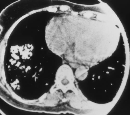Ossificação pulmonar difusa Imagiologia Radiografia Sinais de aumento da AE Opacidades micronodulares calcificadas no parênquima pulmonar Andares