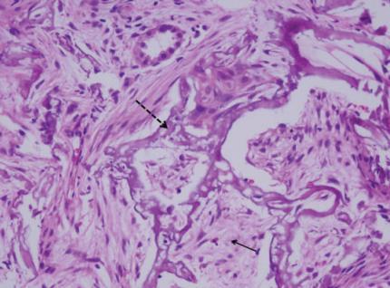 Calcificação metastática Deposição de cálcio em tecido normal Pulmão é dos locais mais frequentes Etiologia DRC Hiperparatiroidismo primário