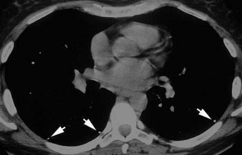 Pneumonia por Varicela