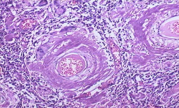 Amiloidose Doença sistémica pela deposição extracelular de amilóide Pode envolver qualquer órgão