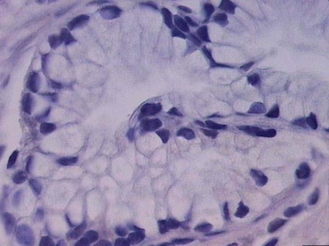 28 A Figura 6. Escore de reatividade quanto à intensidade de coloração imunohistoquímica em campo visual de grande aumento (400x). A. Imunorreatividade ausente em paciente com EB. B.