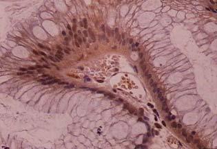 Immunorreativity of c-myc in EB without displasia in 200x (D), EB with displasia in 200x (E) and ACE in 100x (F).