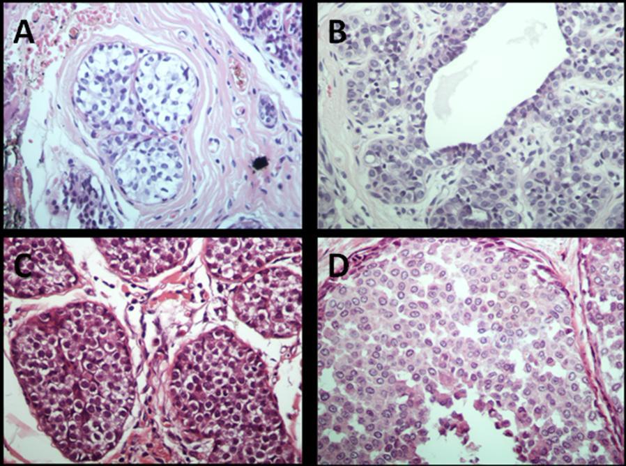 42 Envolvimento ductal por células da hiperplasia lobular atípica ocorre quando as células do CLIS ou HLA se estendem entre a camada epitelial e a membrana basal do ducto terminal.