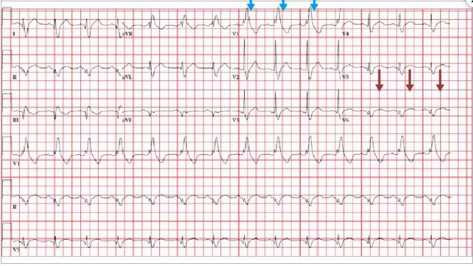 O paciente foi medicado e orientado a fazer acompanhamento cardiológico.