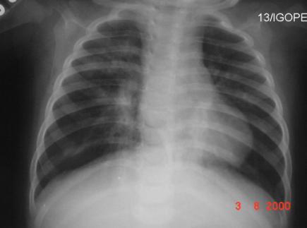 A base de dados. Avaliação da interface. Fig. 1. Raio-x de pneumonia na infância. III.