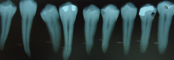 Figura 3: Radiografia em filme oclusal no sentido mésio-distal, com as marcações à 5 mm do ápice 5.