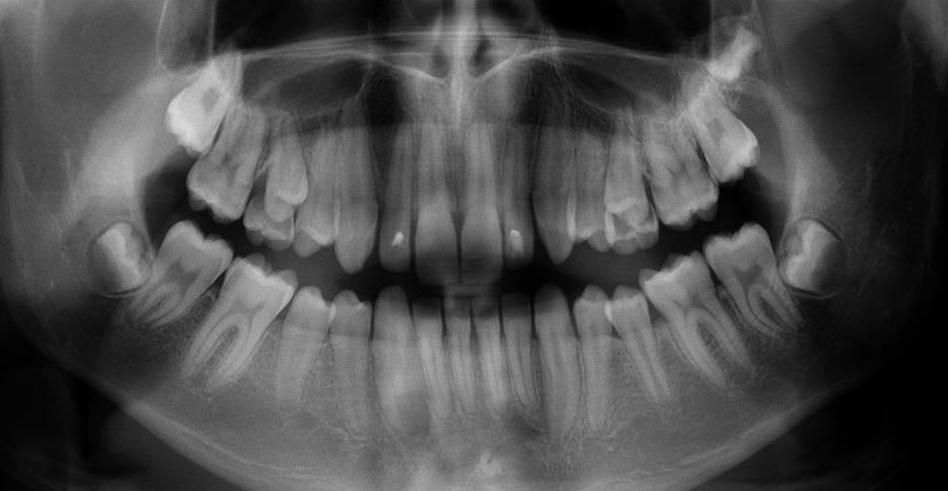 A análise da radiografia panorâmica evidenciou que o paciente encontrava-se no término da dentição mista, logo vindo a esfoliar os segundos molares decíduos superiores.