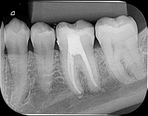 Expansão de Presa Alteração Dimensional A expansão de presa do material diminui a inﬁltração apical, conforme demonstrado pelo estudo abaixo: A ISO deﬁne que a alteração dimensional média do material