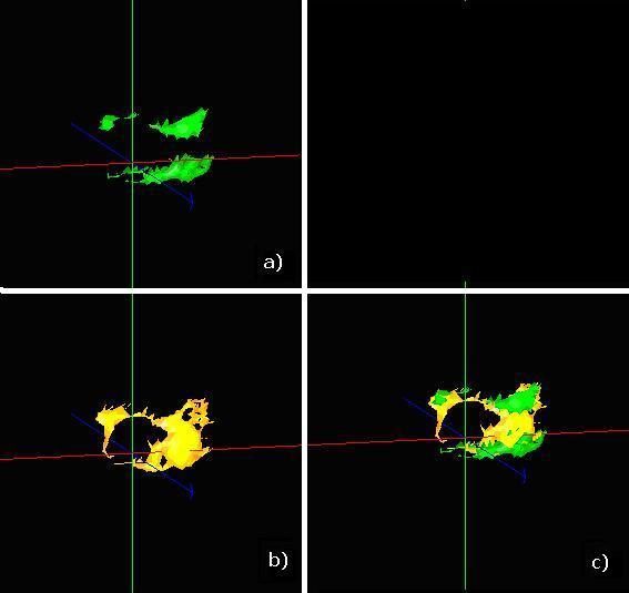 Figura 5.46 Imagens tomográficas de uma amostra de próstata com HPB. 3D microtomomografia por fluorescência de raios X do ferro (Figura 5.