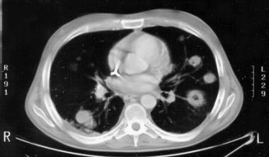 neutropenia grave e prolongada TMO Geralmente > 10 dias Uso