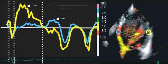 parede lateral parede septal Fig. 3 - Quantificação do atraso eletromecânico intraventricular pelo Doppler tecidual.