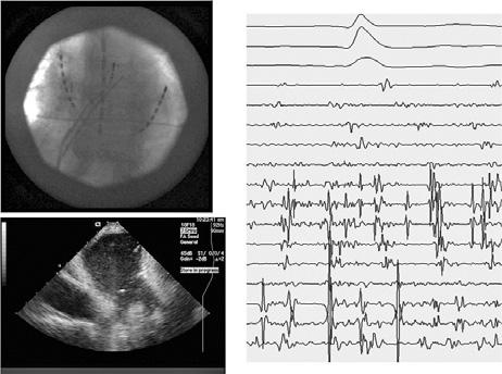 7 evidenciaram o papel fundamental das veias pulmonares (VP) na fisiopatologia dos episódios de FA.