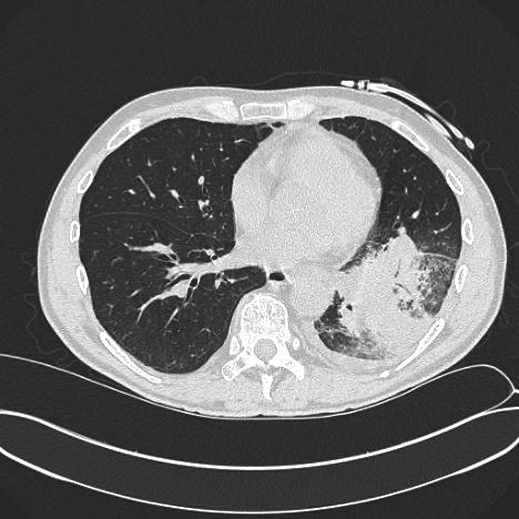 LMA refratária >50 dias de neutropenia Febre