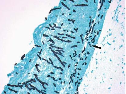 In: Aspergillosis: