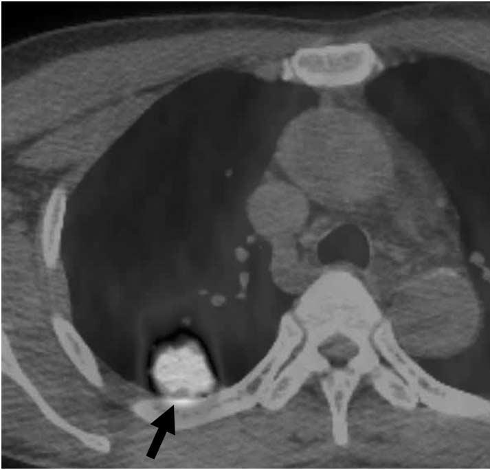 A B Fig. 1. Pulmonary cryptococcosis with clustered nodular pattern in 53-year-old man who had hepatocellular carcinoma (patient 11 in Tables 1, 2). A.