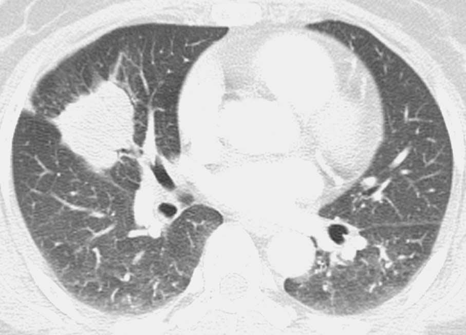 Fig. 5. Pulmonary cryptococcosis of solitary mass pattern in 52- year-old woman with no underlying disease (patient 8 in Tables 1, 2).