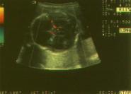 Doppler ultrasom