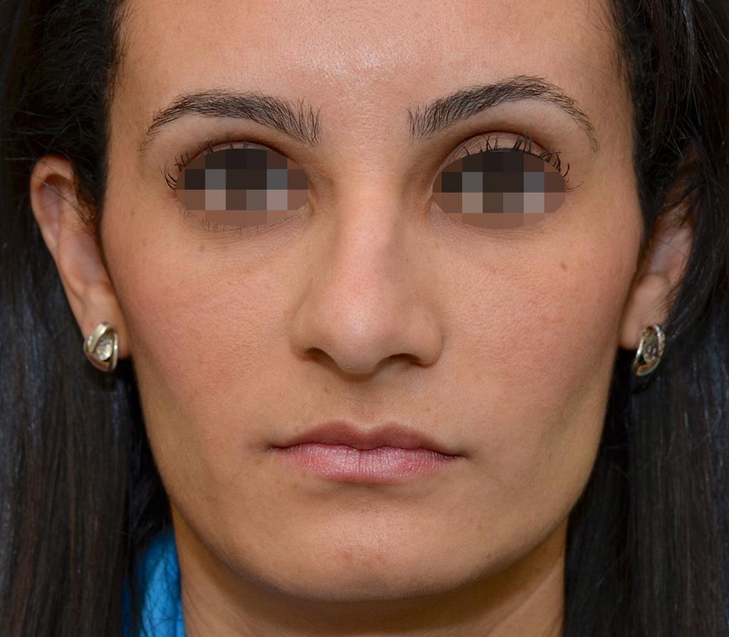 Rinoplastia reparadora: vista basal.