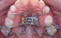 molares permanentes (E, F, G,