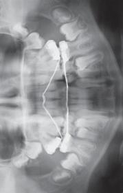 inclinação para a distal, assumida pelo primeiro (16, 26).