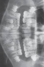 A B C FIGURA 57 Radiografias panorâmicas antes (A), imediatamente após (B) e 14 meses depois da distalização dos primeiros molares superiores permanentes (C).