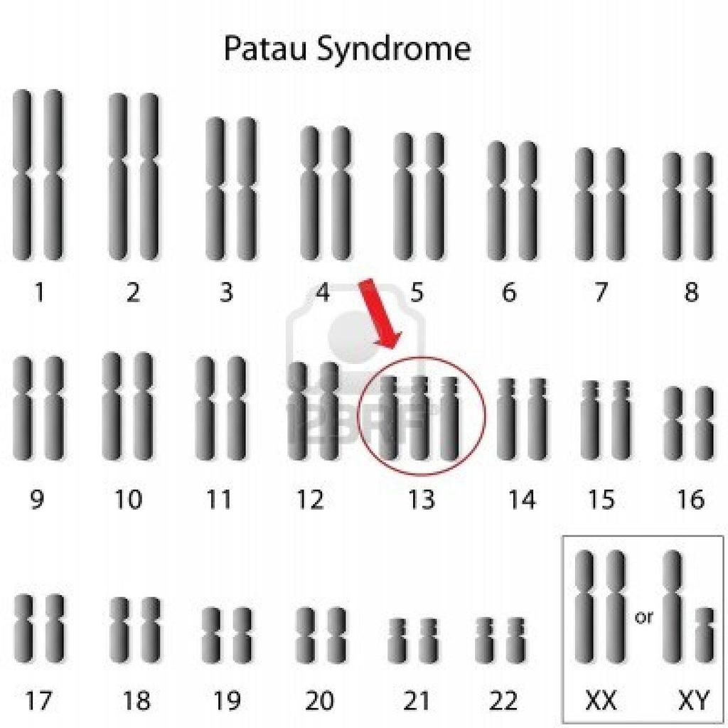 SÍNDROME DE PATAU - CARIÓTIPO