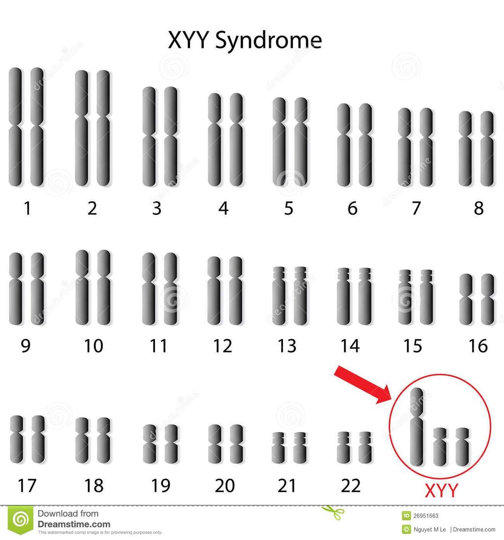 Trissomia do Y (47,XYY)