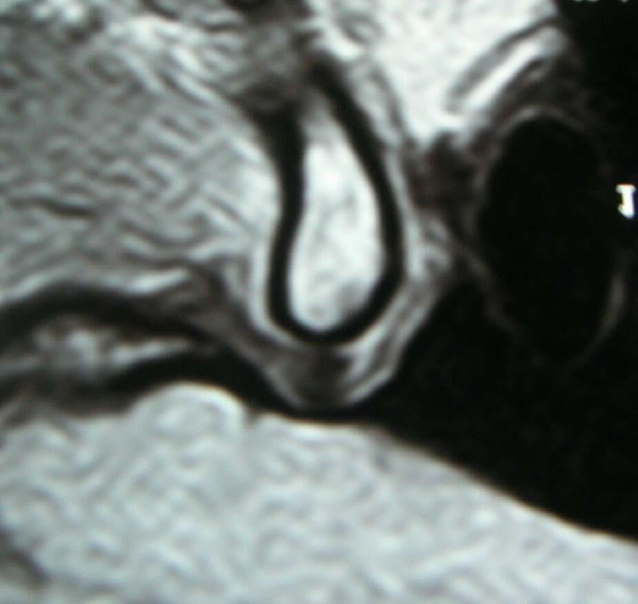 superior e inferior (A); o côndilo mandibular (B); o disco