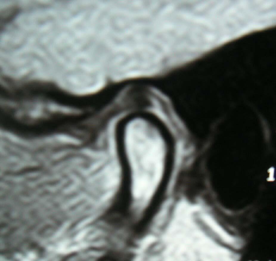 Revisão da Literatura Figura Corte sagital de RM evidenciando o aspecto em gravata borboleta (setas) do disco articular com o