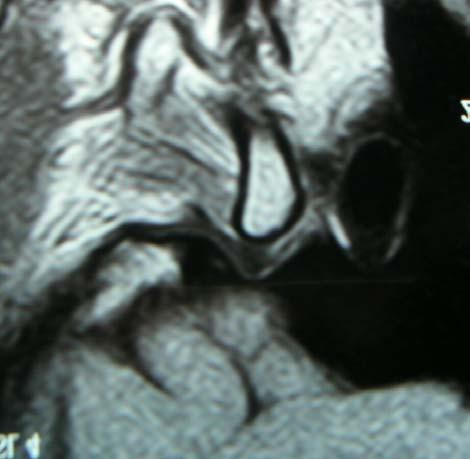 O côndilo mandibular está situado em uma posição central na fossa glenóide e a porção posterior