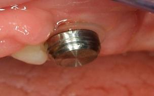 12] é utilizado na fixação direta da matriz, na cavidade oral do paciente.