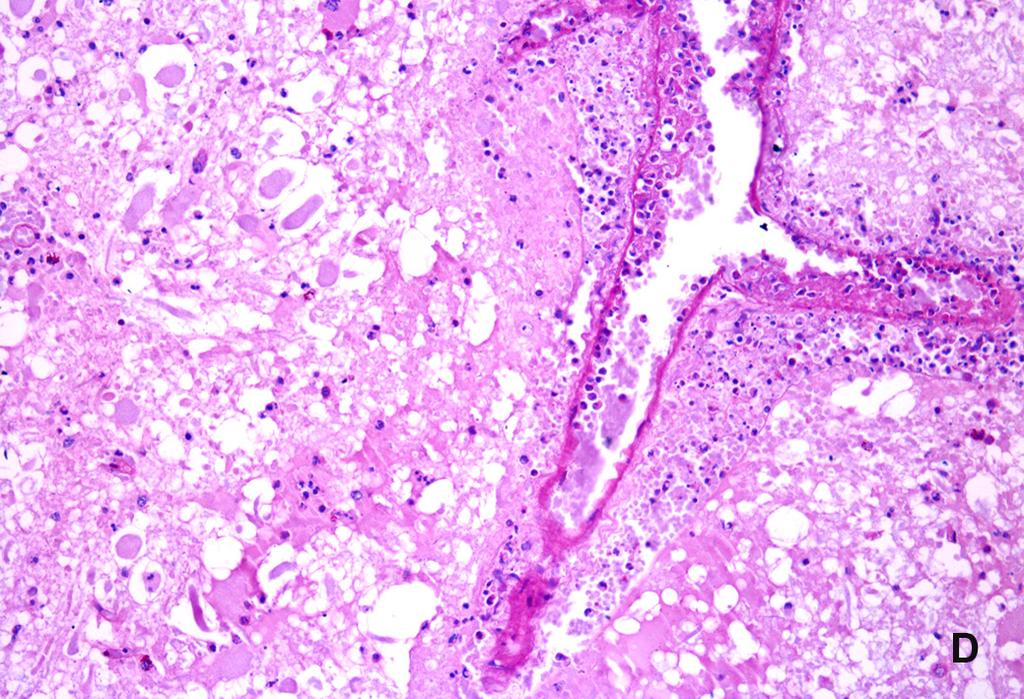 Necrose centrolobular e individual de hepatócitos, além de tumefação hepatocelular acentuada. HE, obj.20x. (B) Encéfalo.