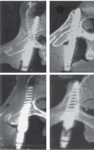 Estudo de acurácia em cirurgia assistida por navegação na revisão cirúrgica de deformidade vertebral 109 A B C D Figura 4. Sistema de Classificação de Rao et al.