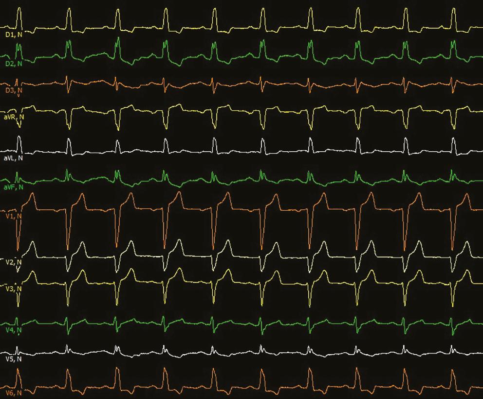 Tomé HP, et al. Figura 1: Eletrocardiograma de 12 derivações em ritmo sinusal. Figura 3: Eletrocardiograma de 12 derivações durante taquicardia. morte súbita cardíaca.