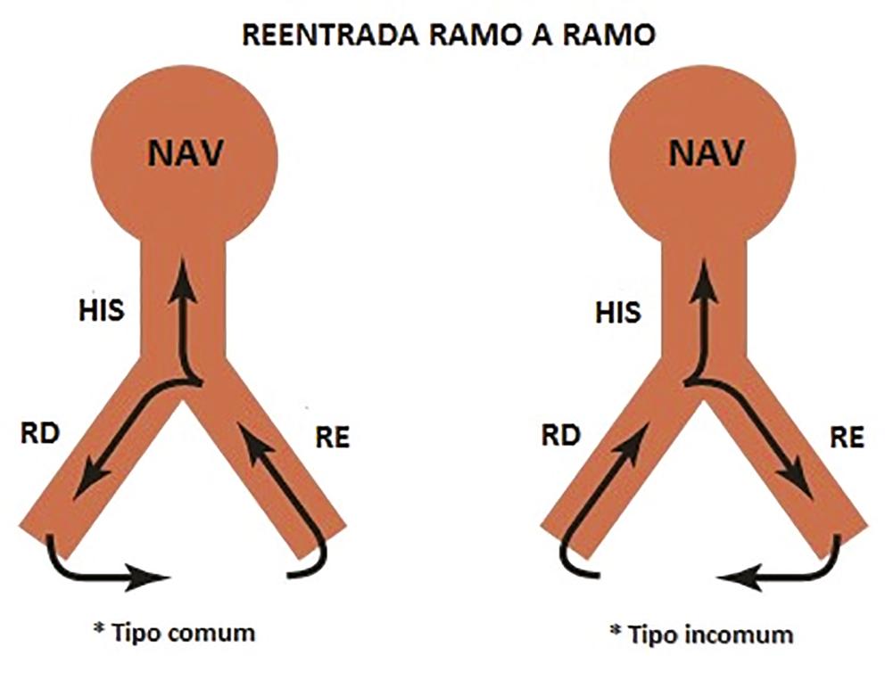 chagásica seria o significativo acometimento do ramo direito (comumente o braço anterógrado do sistema reentrante) identificado nesses pacientes.