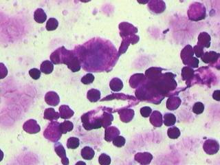 200x, respectivamente, hematoxilina-eosina) - linfoma difuso de grandes células B: 6 pacientes; - linfoma linfoblástico/leucemia linfoblástica de células B precursoras: 1 paciente; - linfoma não