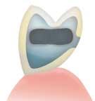 Assim, o correto suporte funcional da estrutura metálica sobre o dente preparado pode ser concretizado.