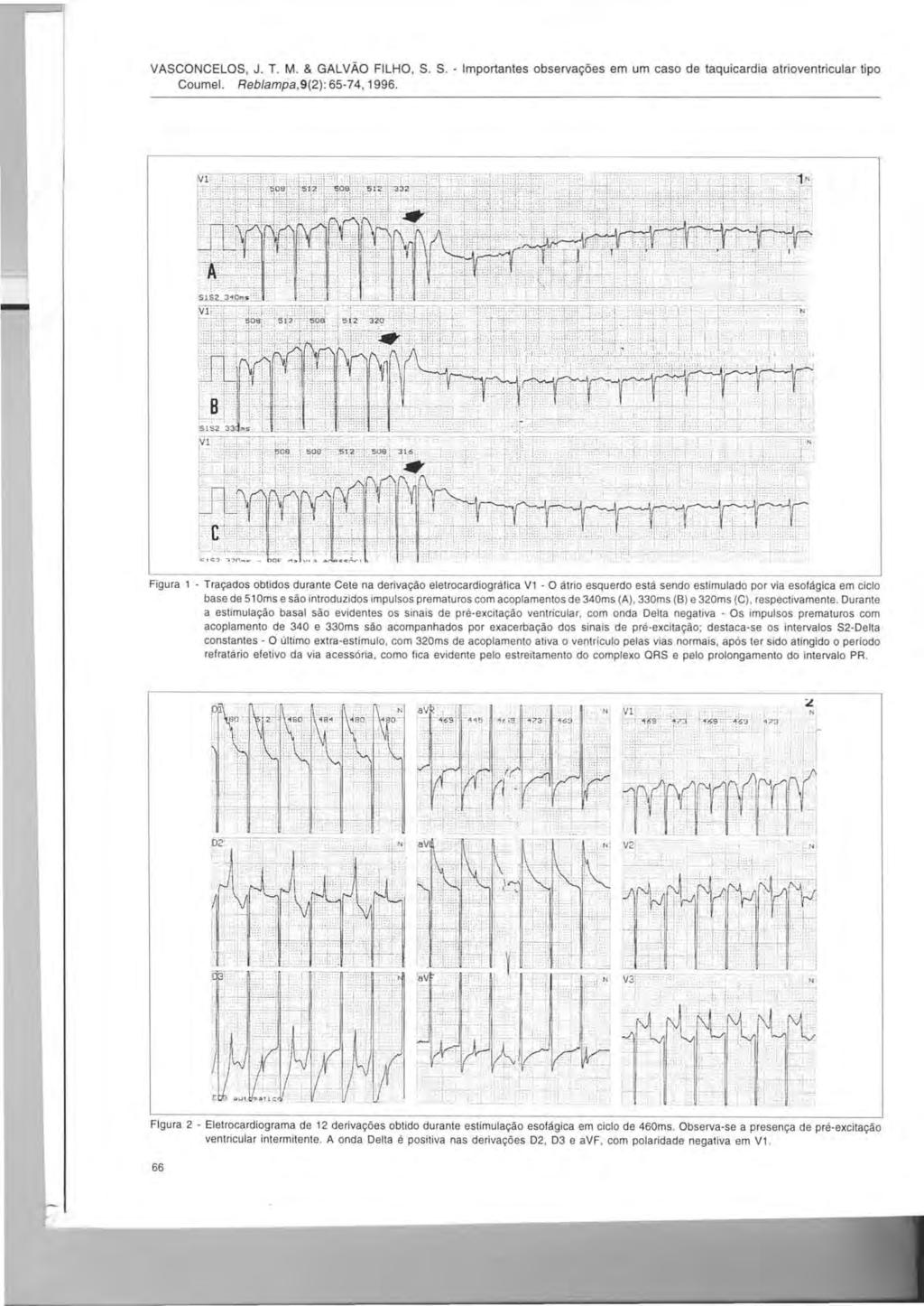 VASCONCELOS, J. T. M. & GALVAO FILHO, S. S. - Importantes observagoes em um caso de taquicardia atrioventricular tipo Coumel. Reblampa,9(2): 65-74,1996.