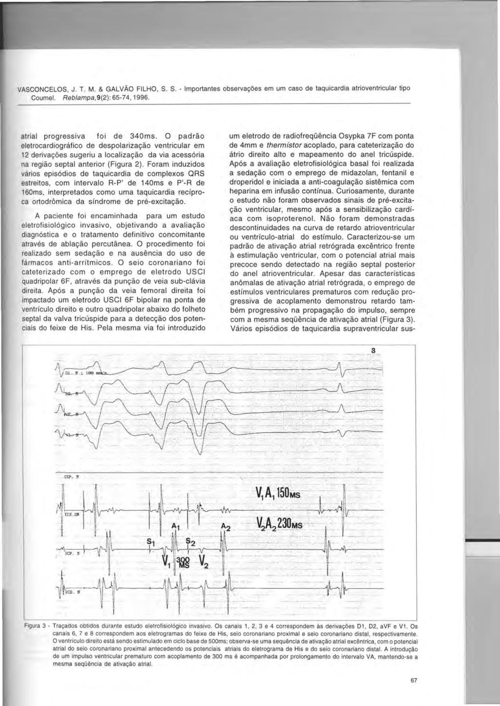 VASCONCELOS, J. T. M. & GALVAO FILHO, S. S. - Importantes observar,:6es em um caso de taquicardia atrioventricular tipo Coumel. Reb/ampa,9(2): 65-74, 1996. atrial progressiva foi de 340ms.