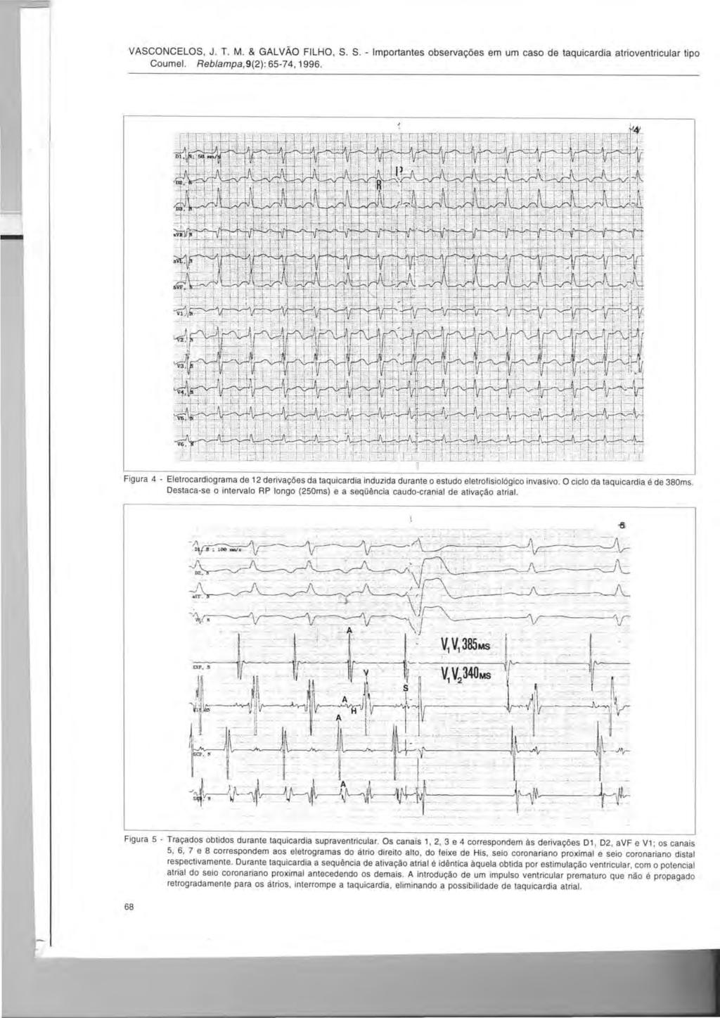 ' -:;:-.' ~-~W r-m -'-'1:::'1 -~.---- --._- VASCONCELOS, J. T. M. & GALVAO FILHO, S. S. - Importantes observa90es em um caso de taquicardia atrioventricular tipo Coumel. Reblampa,9(2): 65-74, 1996.