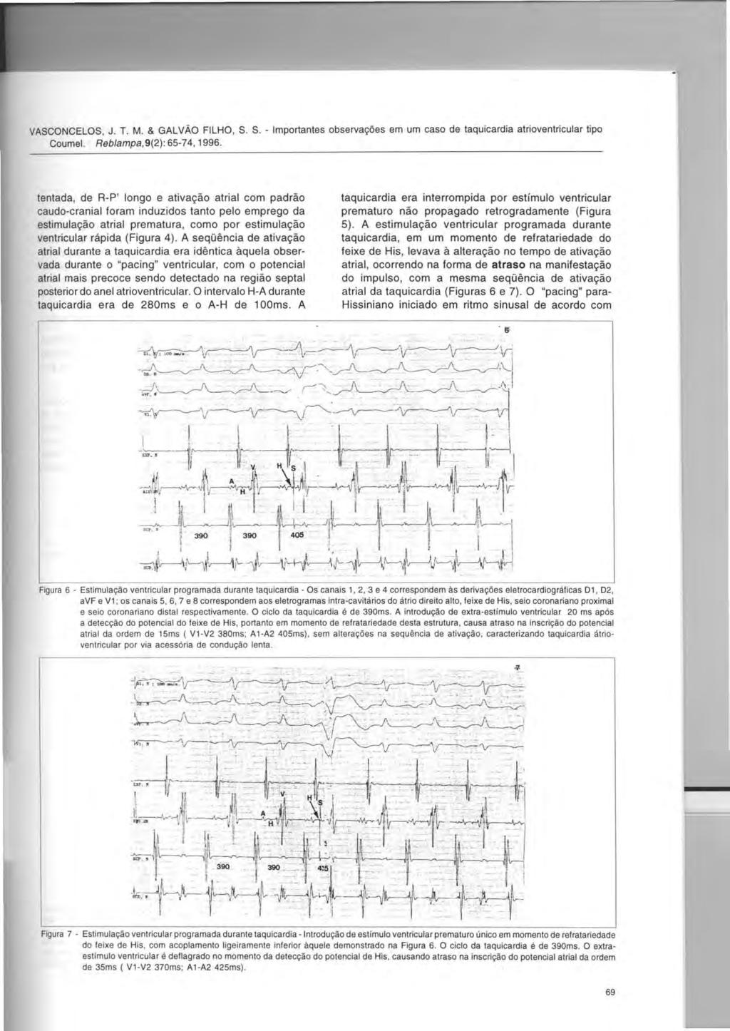 VASCONCELOS, J. T. M. & GALVAO FILHO, S. S. - Importantes observai{oes em um caso de taquicardia atrioventricular tipo Coumel. Reb/ampa,9(2):65-74,1996.