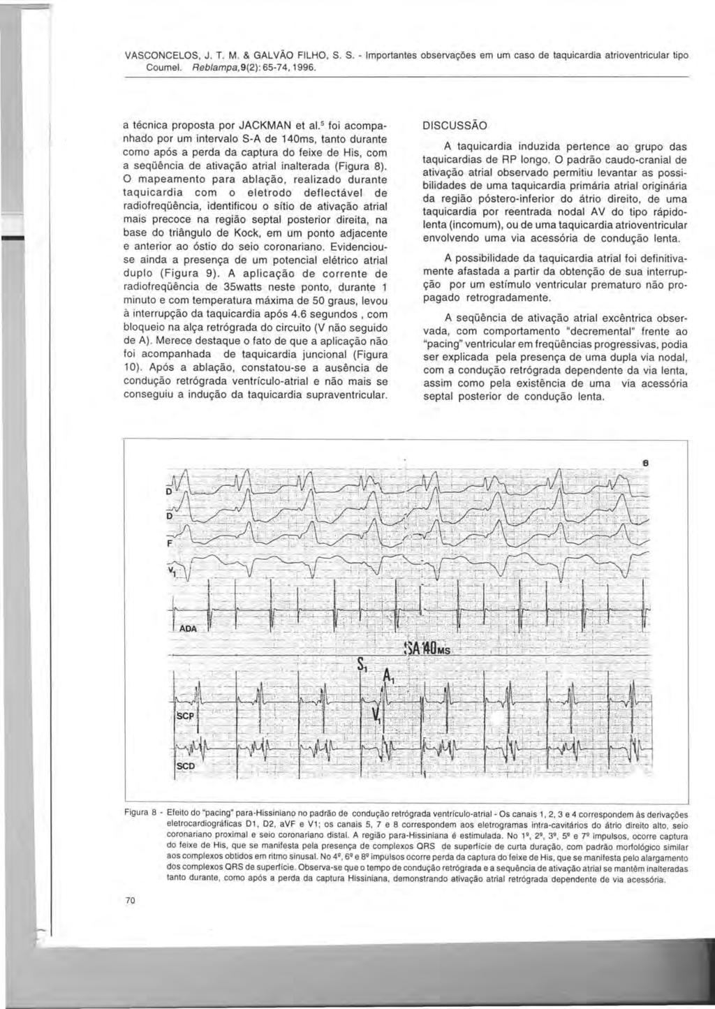 VASCONCELOS, J. T. M. & GALVAO FILHO, S. S. - Importantes observar;:6es em um caso de taquicardia atrioventricular tipo Coumel. Reblampa,9(2): 65-74,1996. a tecnica proposta por JACKMAN et al.