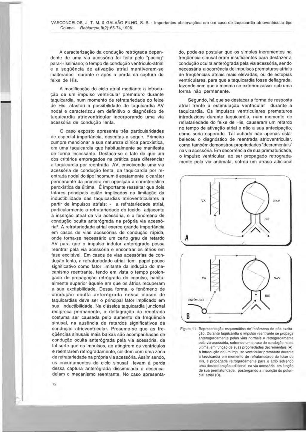 VASCONCELOS, J. T. M. & GALVAO FILHO, S. S. - Importantes observa90es em um caso de taquicardia atrioventricular tipo Coumel. Reb/amjJa, 9(2): 65-74, 1996.