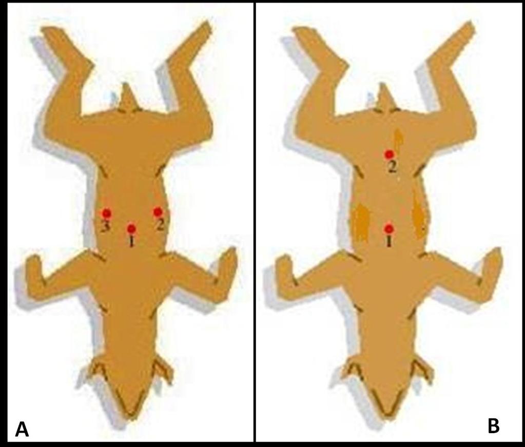 25 Figura 1. Disposição esquemática dos trocartes para realização de OSH laparoscópica com três portais (A) e dois portais (B). Localização da óptica (1) e dos portais de trabalho (2 e 3).