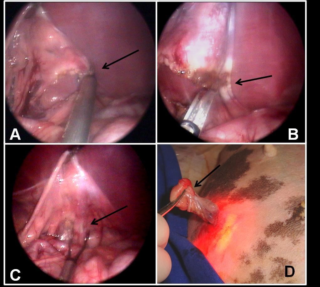 26 Figura 2 - OSH pelo acesso videolaparoscopico com três portais. A e B- Eletrocoagulação e secção do ovário (seta). C- Obliteração uterina com eletrocoagulação (seta).